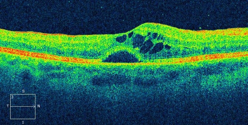 tratar el edema macular