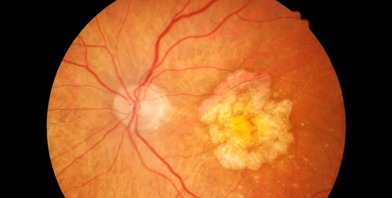 Degeneración macular asociada a la edad