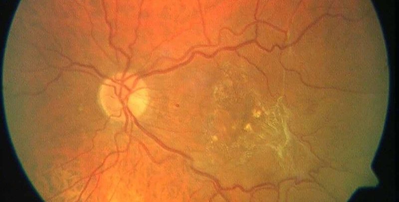 Membrana Epirretiniana Macular